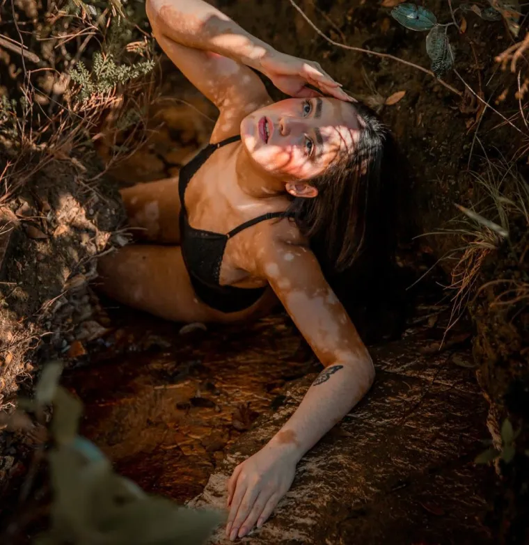 Kožna bolest s kojom se borio i Michael Jackson može biti lijepa: Hrabre žene s vitiligom skinule se do kraja