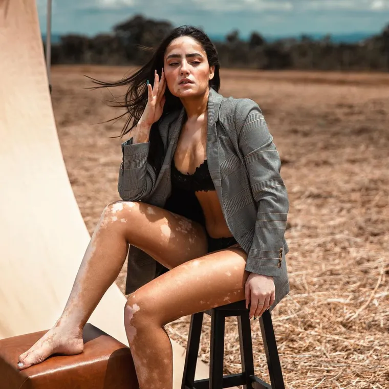 Kožna bolest s kojom se borio i Michael Jackson može biti lijepa: Hrabre žene s vitiligom skinule se do kraja