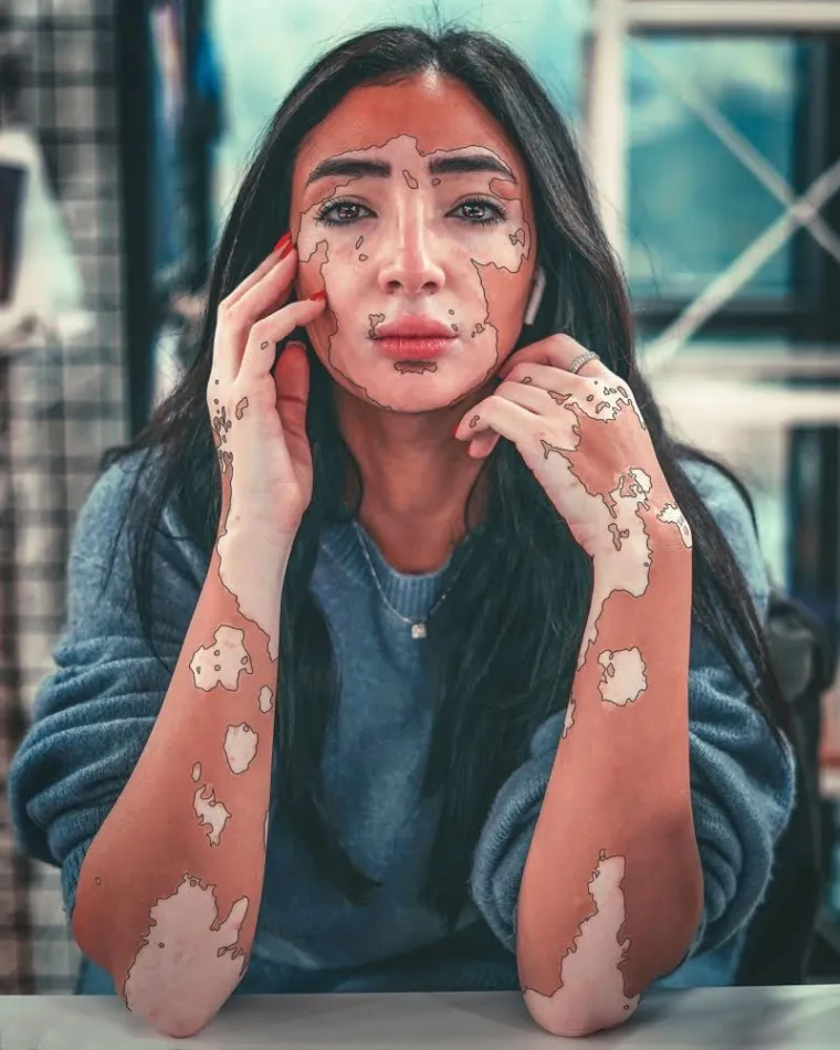 Kožna bolest s kojom se borio i Michael Jackson može biti lijepa: Hrabre žene s vitiligom skinule se do kraja