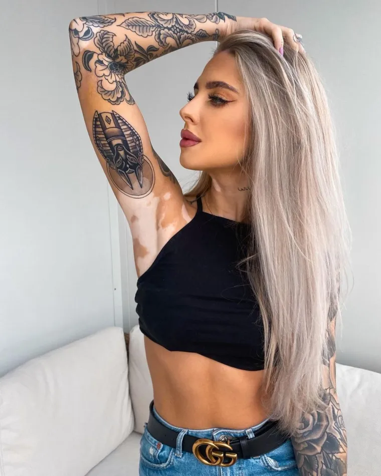 Kožna bolest s kojom se borio i Michael Jackson može biti lijepa: Hrabre žene s vitiligom skinule se do kraja