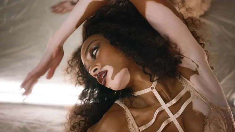 Kožna bolest s kojom se borio i Michael Jackson može biti lijepa: Hrabre žene s vitiligom skinule se do kraja