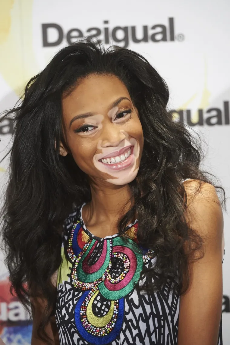 Kožna bolest s kojom se borio i Michael Jackson može biti lijepa: Hrabre žene s vitiligom skinule se do kraja