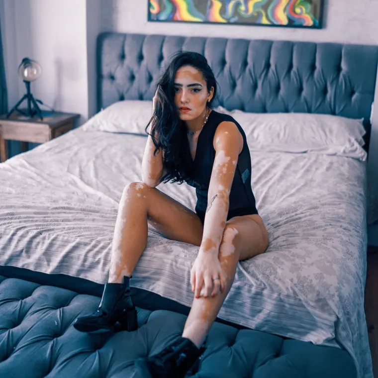 Kožna bolest s kojom se borio i Michael Jackson može biti lijepa: Hrabre žene s vitiligom skinule se do kraja