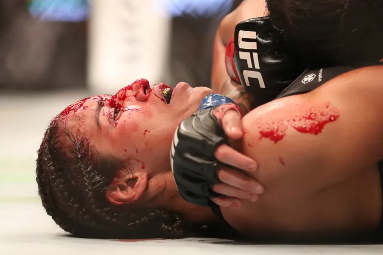 UFC borkinja završila kod plastičnog kirurga nakon užasne ozljede: 'Ostala je bez velikog dijela glave'