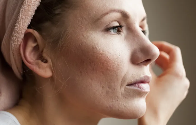 2. Može vam stvoriti akne: Uklanjanje šminke prije spavanja bitan je korak u postizanju čiste i lijepe kože, ali čak i ako se čini da ste skinuli korektor i maskaru, na vašem licu još uvijek može ostati nešto proizvoda koji će se probiti na jastuk i ostati tamo dok se ne ispere. U kombinaciji s vašim znojem i uljima, omogućuje razvoj bakterija i gljivica, što može iritirati vašu kožu, čineći je ranjivijom na prištiće.