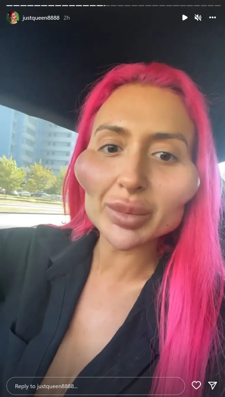 Žena s 'najvećim obrazima na svijetu' pokazala potpuno novi ekstrem: 'Ako me danas vidite u gradu s rogovima...'