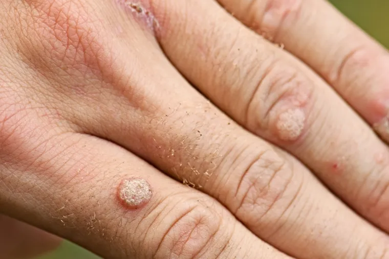 4. Što je s bradavicama: Postoji još jedna vrsta kožnih bolesti koja je, za razliku od madeža, uzrokovana prilično čestim virusom koji se zove humani papiloma virus (HPV) i prenosi se izravnim kontaktom s kožom ili preko zajedničkih predmeta kao što su ručnici ili krpe za pranje. Obične bradavice obično su bezopasne i s vremenom nestaju same od sebe. Obično se pojavljuju na prstima ili rukama, karakterizira ih grubost i često imaju uzorak sitnih crnih točkica, koje su male krvne žilice zgrušane krvi. Drugi se mogu pojaviti na tabanima i stoga uzrokovati nelagodu pri hodu. 