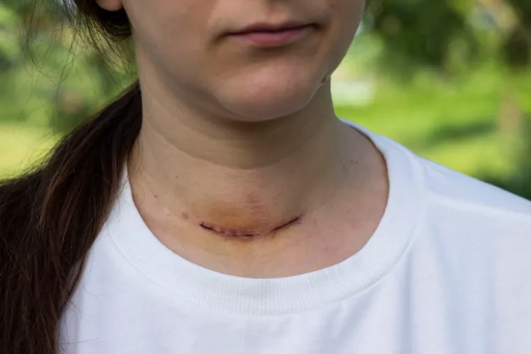 5. Komplikacija ožiljaka: Posljedica ožiljka je i limfni zastoj i pojava otoka, najčešće ruku, koji su kronični po svom toku s mogućim komplikacijama. Nastaju i zbog oštećenja limfnih čvorova i limfnih puteva tijekom operacija, povreda ili uslijed bolesti. &quot;Mogu se javiti nove rane na starom ožiljku, zatim rascjep ožiljnog tkiva, zgrčenost mišića, skraćenje mišićno-zglobnih pripoja, smanjenje funkcije, nastanak tumora (karcinoma) na bazi ožiljaka, ali i psihološke i socijalne posljedice&quot;, rekla je dermatologinja.