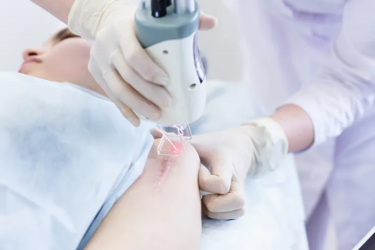 6. Svježi ožiljci su osjetljivi na UV zračenje: Prema riječima doktorice Delić, prevencija je prije svega dobra operativna tehnika i neposrednija postoperativna primjena terapije, koja sprječava pojavu nefizioloških oblika ožiljaka, infekciju, gubitak hidriranosti ožiljaka. &quot;Na raspolaganju su primjena silikona u obliku pločica, biostimulativnih neablativnih lasera, faktora rasta, hijalurona, suspenzija stanica, preparata koji čuvaju vlažnost tkiva ožiljka, fizikalna terapija, hidroterapija. Pri tome treba imati u vidu i da su svježi ožiljci osjetljivi na UV zračenje, na hladnoću, saunu, vježbe istezanja i snage, usku odjeću&quot;, dodala je.
