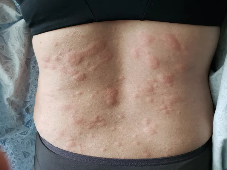 Osip - Ako vas iznenada prekriju crvene kvržice koje svrbe, možda je kriv stres, a ne alergija. Kada vaše tijelo doživi pretjerani stres, bilo na kratko ili na duže vrijeme, vaš imunološki sustav slabi i vaše tijelo počinje otpuštati kemijski histamin kako bi se borilo protiv bolesti. Ako stres ne nestane, razvit ćete alergijsku reakciju te dobiti osip nalik koprivnjači. Što učiniti: na dio tijela na kojem se pojavio osip treba se staviti hladan vlažni ručnik. Ako to ne pomogne, uzmite antihistaminik.