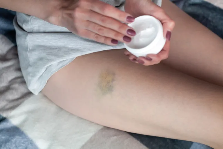 6. Kožni problemi - Modrice, fleke na koži, suhoća kože i pukotine u uglu usana samo su neke od vidljivih promjena na koži do kojih dolazi uslijed nedostatka vitamina C u vašem organizmu. 