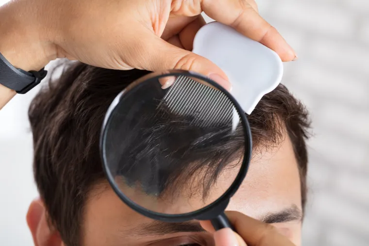 Iščešljavanje kose:  Nakon pripreme, bilo da ste oprali kosu specijaliziranim šamponom ili prirodnim pripravkom, slijedi mukotrpniji posao. Bit će vam potreban bijeli regenerator, papirnate maramice ili salvete bez uzorka i uski specijalni češalj s metalnim zupcima. Operite kosu, gusto nanesite regenerator i češljajte pramen po pramen. Sadržaj češlja brišite u maramicu svaki put kada prođete češljem kroz kosu. Od pomoći će vam biti i špangice kako biste razdijelili kosu koji ste već pregledali i pročešljali. Pritom je dobro da to radite u dobro osvijetljenoj prostoriji, pod stolnom lampom, a mnogima je najpraktičnija naglavna svjetiljka. 
