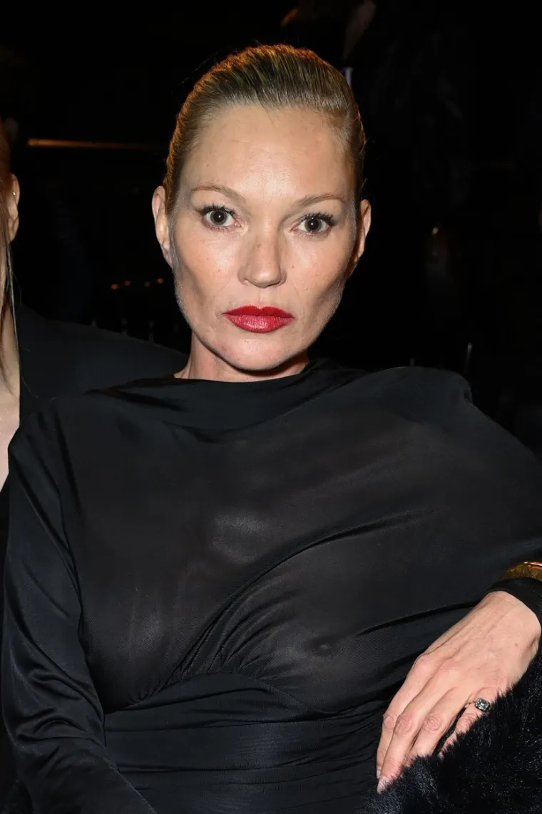 Supermodel Kate Moss je priznala da ne voli svoje iskrivljene noge. Izbjegava nositi odjeću i obuću koja seže do sredine listova. Zbog toga je se često može vidjeti u vrlo kratkim suknjama i haljinama, a ona zna i često namjerno rezati odjeću.