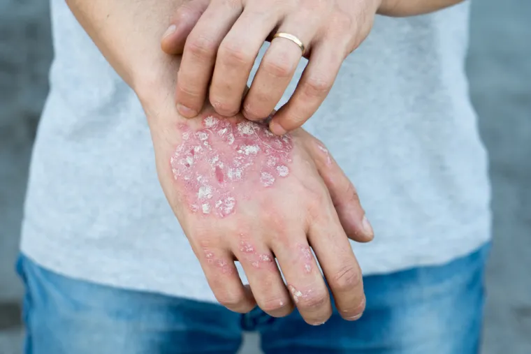4.Crvene ljuskice ili gnojne izbočine: Psorijaza je nevjerojatno često kronično autoimuno stanje koje uzrokuje ljuskanje na površini kože i može se pojaviti na rukama ili noktima. &quot;Psorijaza na rukama može izgledati kao crvene, ljuskave, uzdignute pločice i ponekad može uključivati pustule—bijele gnojne kvržice—na dlanovima&quot;, kaže dr. De la Feld.  Promjene na noktima, poput udubljenja, žućkastih mrlja ispod nokta ili odvajanja nokta od ležišta nokta, također se mogu pojaviti, dodaje ona. Ako mislite da imate psorijazu, važno je postaviti dijagnozu. Kao što dr. De la Feld ističe, &quot;psorijaza može biti povezana sa stvarima kao što su artritis i kardiovaskularne bolesti.&quot;