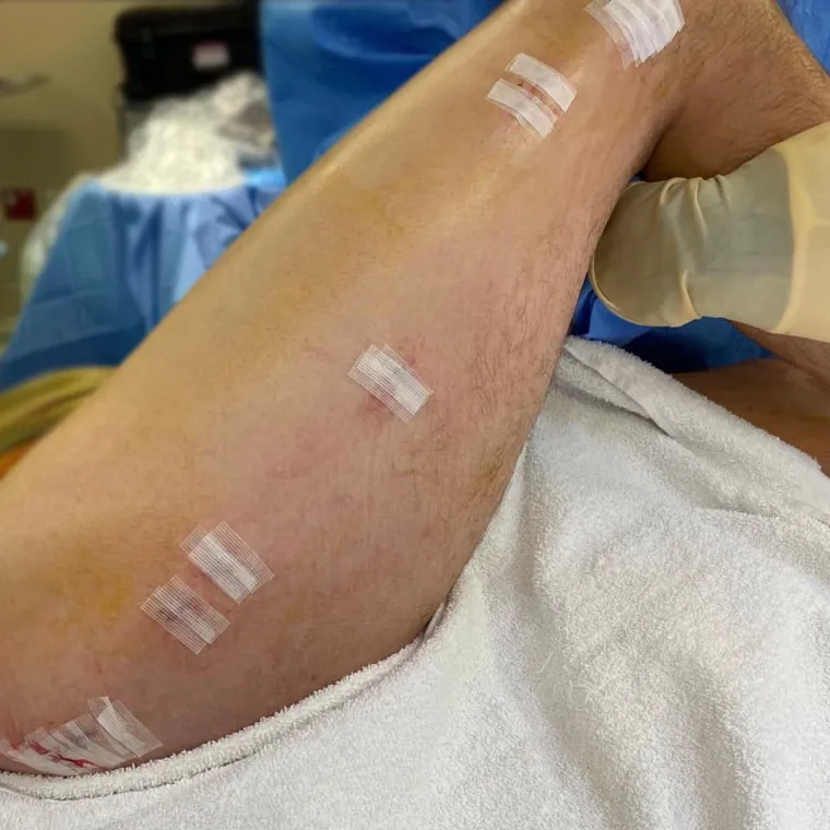 Neki ljudi nakon operacije primorani su biti u invalidskim kolicima te im je potrebna fizioterapija. Unatoč strahovima, nekoliko klinika u Ujedinjenom Kraljevstvu je izvjestilo da raste zanimanje za operaciju. Ne vode se službeni podaci o tome koliko se zahvata produljivanja nogu napravi u svijetu. Operaciju je ranih 1950-ih kao način liječenja ozljeda vojnika razvio sovjetski liječnik Gavriil Ilizarov. 