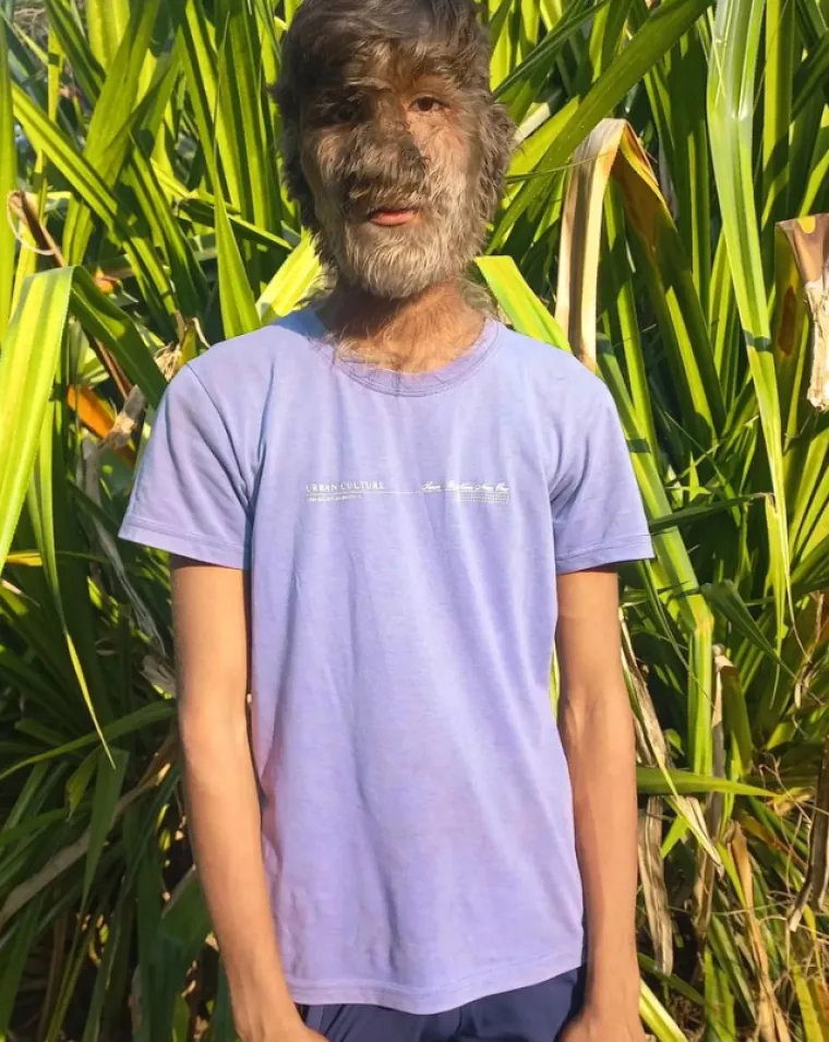 Jo&scaron; uvijek ne postoji lijek za hipertrihozu. Oboljeli jednostavno poku&scaron;avaju vi&scaron;egodi&scaron;nju grivu držati pod kontrolom izbjeljivanjem, &scaron;i&scaron;anjem, brijanjem, depilacijom voskom, laserima i drugim metodama uklanjanja dlačica.