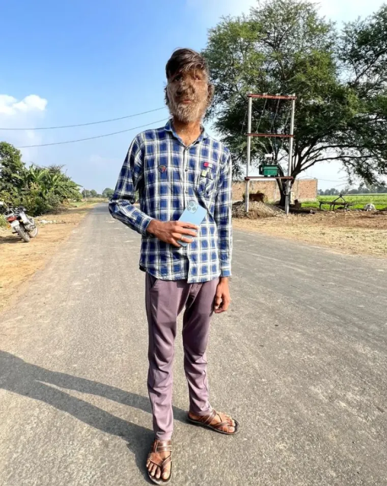 U novijem primjeru prije nekoliko godina, djeci u &Scaron;panjolskoj izrasle su dlake po cijelom tijelu nakon &scaron;to su slučajno dobili lijek protiv gubitka kose za probavne smetnje.