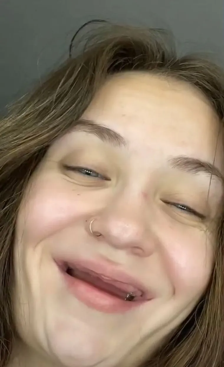 Gotovo 15.000 ljudi gleda njezina videa na TikToku. Prate njezin život nakon vađenja zuba i slušaju je kako objašnjava kako se nosi s time.