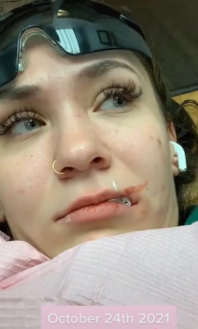 Priznala je da je izgubila zube od bolesti: &quot;Zubi su mi bili tako nagriženi i pokvareni. Mogla bih ih pokušati spasiti krunicama, ali vjerojatno ne bi izdržale ni nekoliko mjeseci. S 19 godina si nisam mogla priuštiti prave.&quot;