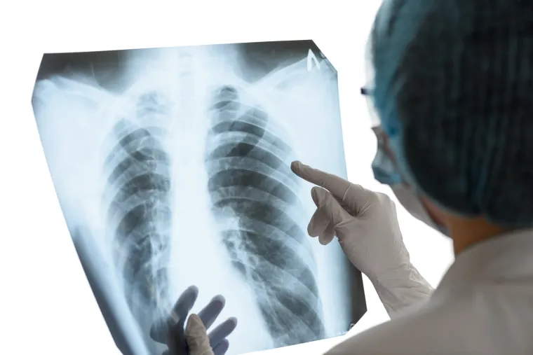 Upala pluća se razlikuje od bronhitisa po tome što je kod upale pluća infekcija prisutna u mjehurima pluća, kroz koje se vrši razmjena plinova. S druge strane, bronhitis je stanje kod koga su infekcijom zahvaćene bronhije - cjevčice koje zrak provode od dušnika do pluća. Ako se bronhitis ne liječi, može prijeći u upalu pluća. 