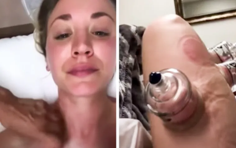 Nakon intenzivnih treninga Kaley Cuoco odlučila je isprobati cupping. “Tjednima se zapravo nisam mogla pomaknuti. Vaši živci i ligamenti postaju bolji.&quot;