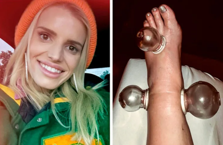 Jessica Simpson tijekom trudnoće isprobala je cupping terapiju zbog jako natečenih stopala. Imala je 3 različite &quot;čašice&quot; koje su joj radile na stopalu; a nakon tretmana stopalo joj se smanjilo.