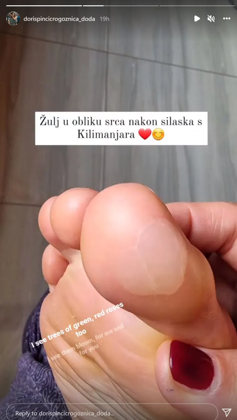 Pinčić je nakon spusta s Kilimandžara podijelila i sliku žulja u obliku srca. 