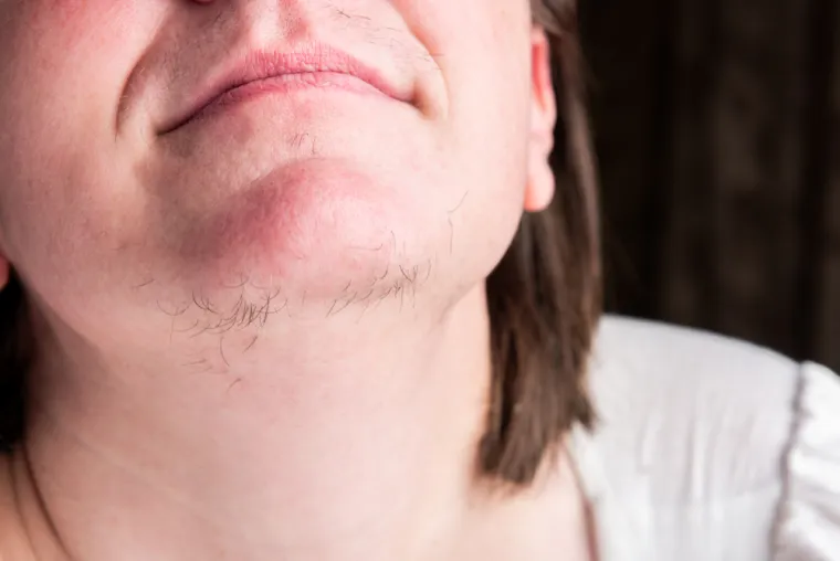 3. Dlake na licu: Zalutale dlačice na bradi i gornjoj usnici, kao i pojava zalistaka, česta su pojava kod žena i mnogima je to neugodno. Ovo je znak visoke razine testosterona i nusprodukta koji se zove dihidrotestosteron (DHT), jedan od spolnih hormona. Muškarcima je potreban za razvoj muških karakteristika, ali ga proizvode i žene, a može dovesti do prekomjernog rasta dlaka na tijelu. 