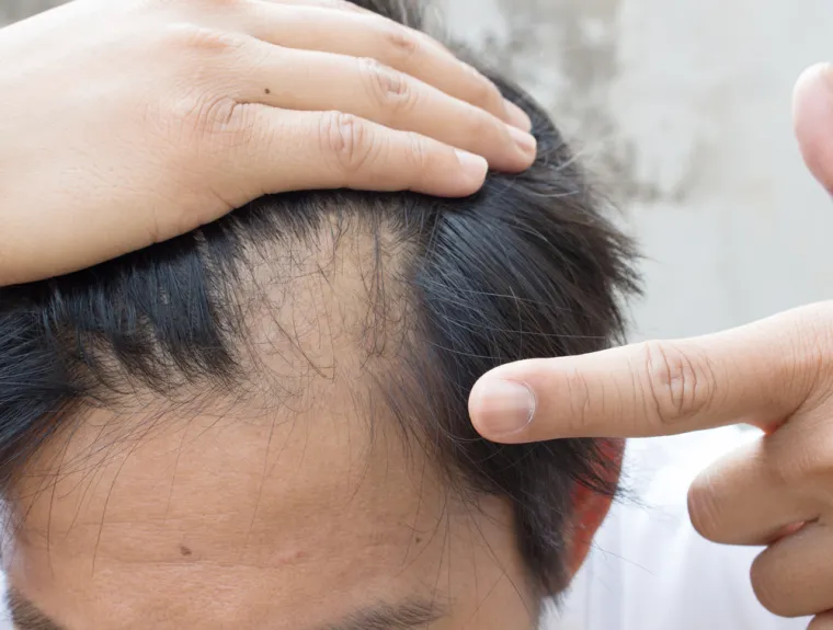 4. Ćelavost: Nisu samo muškarci ti koji mogu oćelaviti kako stare. Ženska ćelavost – poznata kao androgena alopecija je nasljedna i pokazuje se kao širi središnji razdjeljak koji se širi od tjemena. Nositelji imaju genetski uvjetovano skraćivanje faze rasta životnog ciklusa dlake, što postaje očitije kasnije u životu kada se razina estrogena koji regulira ovaj proces smanjuje. Hormonske promjene menopauze također imaju drugi štetan učinak. 