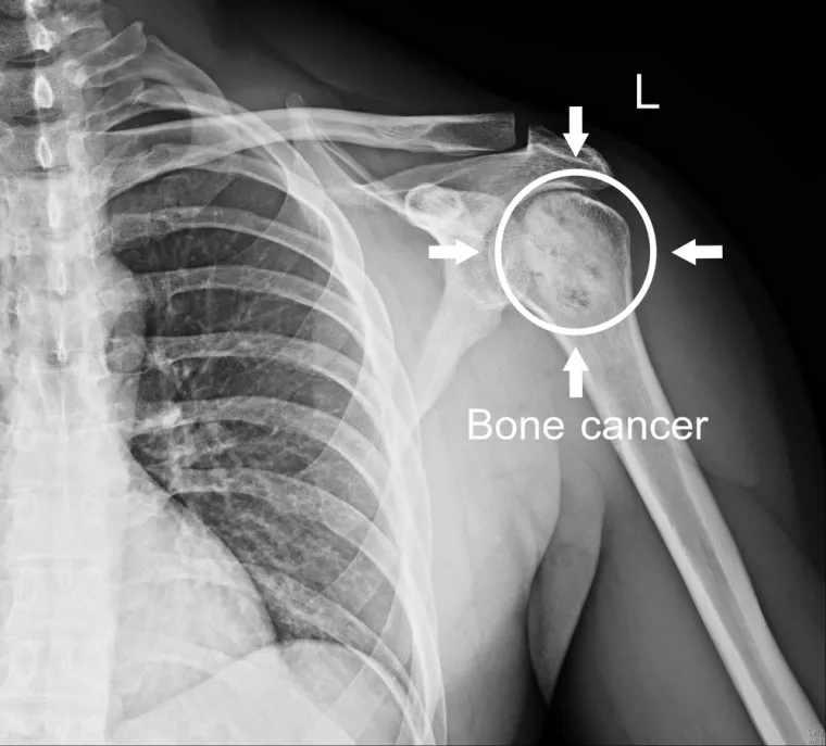 Tipovi raka kostiju mogu biti: nekancerozni ili benigni  (osteohondromi, benigni hondromi, hondroblastomi, hondromiksoidni fibromi, osteoidni osteomi, gigantocelularni tumori). Kancerogeni  ili maligni (osteosarkom, fibrosarkomi, maligni fibrozni histiocitomi, Ewingov tumor, maligni limfomi kosti, multipli mijelom). Metastatski – tumori kosti koji se šire u kost od mjesta nastanka koji mogu biti bilo gdje u tijelu.