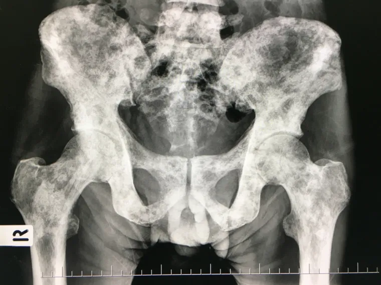 1. Osteosarkom: Osteosarkom počinje u stanicama kostiju. Riječ je o drugom najčešćem malignom tumoru kosti. Osteosarkom se većinom pojavljuje kod djece i adolescenata, dakle od 10. do 20. godine života, ali se može javiti bilo kada. Starije osobe koje pate od Pagetove bolesti ponekad dobiju ovu vrstu tumora. Većina osteosarkoma se razvija kod pacijenata koji nemaju nikakvih drugih bolesti i kod onih koji nemaju tumore u povijesti obiteljske bolesti. Otprilike polovica osteosarkoma se javlja u području koljena, no tumor se može razviti u bilo kojoj kosti. Osteosarkom ima tendenciju širenja na pluća. 