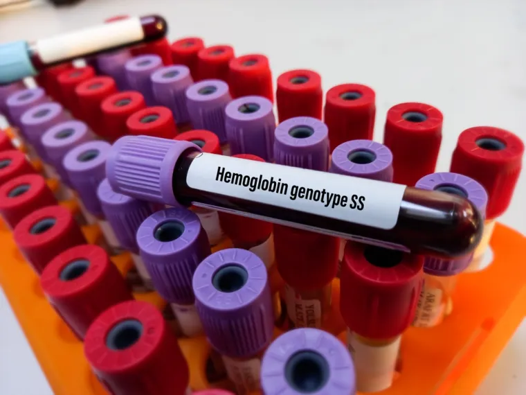 2. Hemoglobin je bjelančevina u eritrocitima koja prenosi kisik iz pluća u sve stanice tijela. Postoje bolesti u kojima eritrociti ne stvaraju dosta hemoglobina ili stvaraju hemoglobin drugačijeg sastava od normalnog pa stanice organizma trpe zbog nedostatka kisika. Snižene vrijednosti hemoglobina imaju bolesnici s anemijom. U bolesnika s anemijom nalazi se obično nizak broj eritrocita i niske vrijednosti hemoglobina.