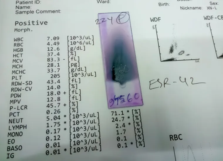3. MCV – prosječan volumen eritrocita. To je indeks koji nam daje uvid u veličinu eritrocita. Maleni eritrociti nazivaju se mikrociti a veliki makrociti i megaloblasti. Promjene veličine eritrocita nalazimo u stanjima kod kojih je poremećeno normalno sazrijevanje eritrocita.