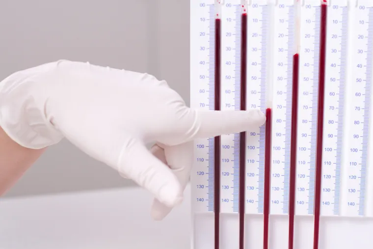 6. RDW je indikator varijacije veličine eritrocita u krvi jer se u krvi se mogu nalaziti eritrociti različite veličine. To je nekada važno za točnu dijagnozu hematološkog poremećaja.