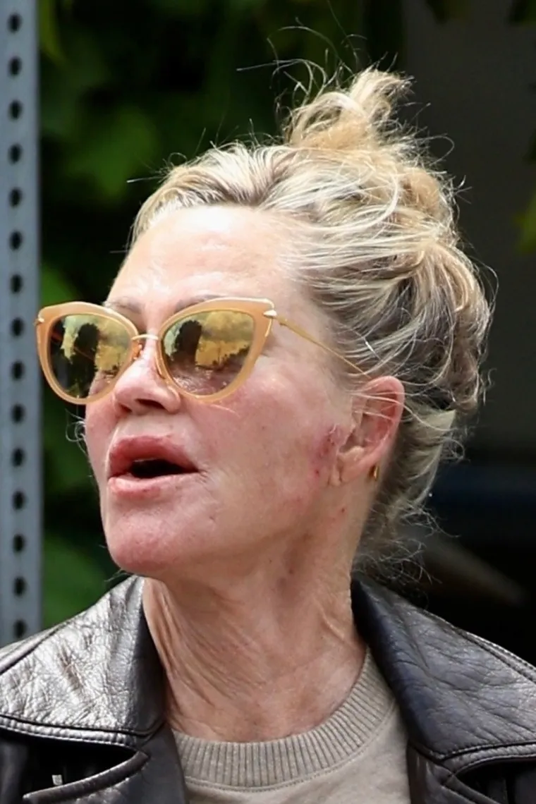 Melanie Griffith zabrinula fanove pojavivši se s neobičnim ožiljcima na licu i rukama: Ovo je izdanje šokiralo svijet