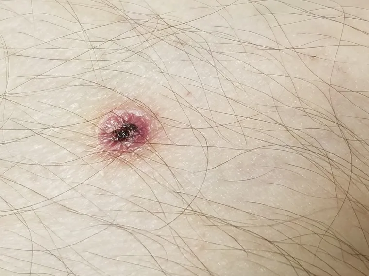 Nodozni eritem obično se poklapa s upalnim procesima crijeva koji su povezani uz Crohnovu bolest, ali se može ublažiti liječenjem. Također, oboljeli može dobiti pyodermu gangrenosum koju očituju osjetljivi mjehurići ili pustule, koji postaju bolni, duboki čirevi. Mogu se pojaviti bilo gdje na koži, ali najčešće se pojavljuju na potkoljenicama ili blizu stome. Pyoderma gangrenosum ponekad je povezana s pogoršanjem simptoma Crohnove bolesti, ali ne uvijek.