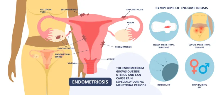Naveo je niz stanja koja čine vašu menstraciju posebno bolnom: 1. Endometrioza 