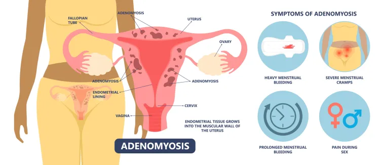 2. Adenomioza 