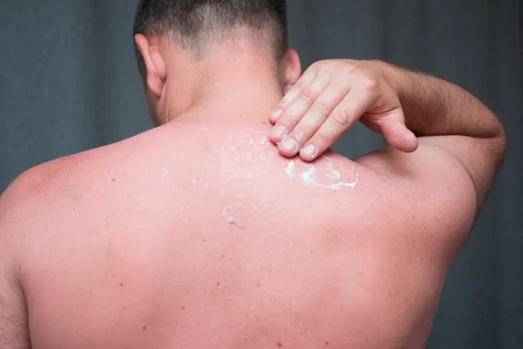 3. Aloe vera gel. Kada se radi o izravnom nanošenju stvari na kožu opečenu suncem, većina ljudi pomisli na preparate nakon sunčanja. Ali takvi proizvodi zapravo mogu pogoršati stanje kože. Stručnjakinja za njegu kože Michaella Bolder rekla je za The Independent: &quot;Formule za poslije sunčanja obično imaju bogatu, gustu konzistenciju koja sadrži ulja, koja stvaraju omekšavajuću barijeru na vrhu kože. To zadržava toplinu u gornjem sloju epidermisa te pogoršava upalu i osjećaj peckanja. Osim toga, mnogi takvi preparati sadržavat će kemikalije i/ili mirise. To će samo iritirati oštećenu kožu&quot;.