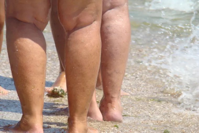 Otečeni zglobovi, višak kilograma i pospanost, samo su neki od simptoma koji ukazuju na ovaj problem.