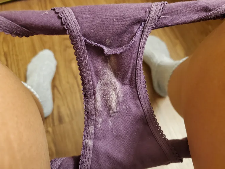 1. Pojačan iscjedak: Vaginalne infekcije se manifestiraju promjenom boje i konzistencije vaginalnog iscjetka i ovo je najčešći razlog zbog kojeg žene posjećuju ginekologe. Vaginalni iscjedak je normalna pojava kod svake žene. Međutim, kada dođe do vaginalne infekcije, on se mijenja. Može biti sivkast ili bijel, obilan, a često je praćen neugodnim mirisom.