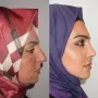 Turska klinika hvali se na Instagramu nevjerojatnim transformacijama pacijenata