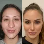 Turska klinika hvali se na Instagramu nevjerojatnim transformacijama pacijenata