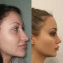 Turska klinika hvali se na Instagramu nevjerojatnim transformacijama pacijenata