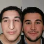 Turska klinika hvali se na Instagramu nevjerojatnim transformacijama pacijenata