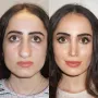 Turska klinika hvali se na Instagramu nevjerojatnim transformacijama pacijenata