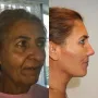 Turska klinika hvali se na Instagramu nevjerojatnim transformacijama pacijenata