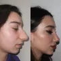 Turska klinika hvali se na Instagramu nevjerojatnim transformacijama pacijenata