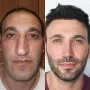 Turska klinika hvali se na Instagramu nevjerojatnim transformacijama pacijenata