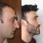 Turska klinika hvali se na Instagramu nevjerojatnim transformacijama pacijenata